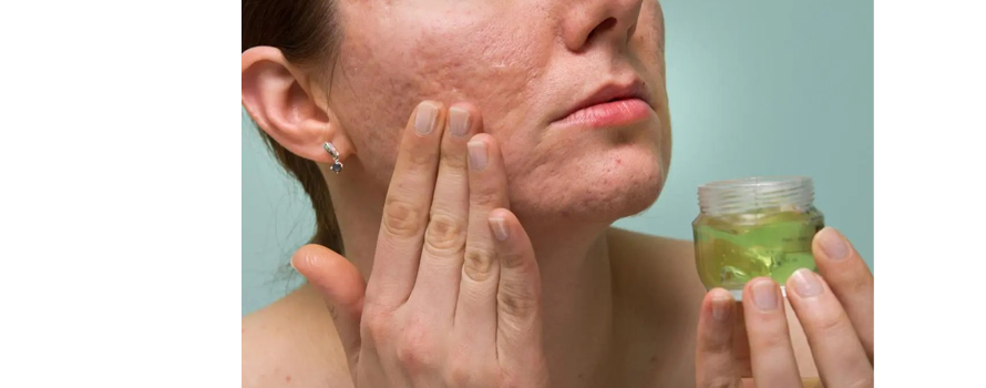 Acne Control in Ayurveda