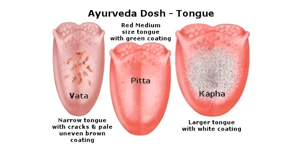 Tongue by Dosha
