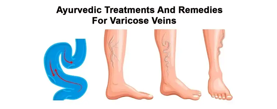 Ayurvedic Treatments And Remedies For Varicose Veins1