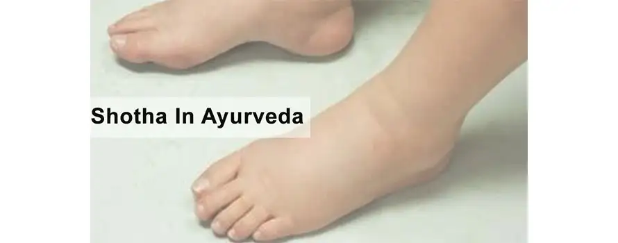 Shotha In Ayurveda 1