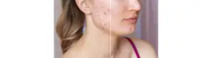 Acne Removal Treatment in Ayurveda 1