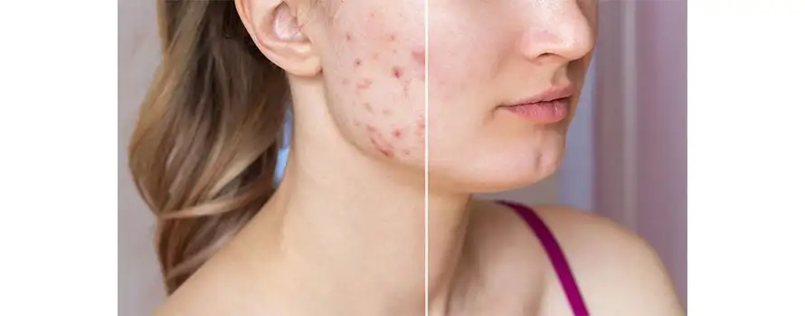 Acne Removal Treatment in Ayurveda 1
